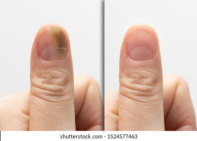 Nail Fungus Hd Stock Images Shutterstock