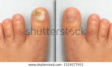 Before and after successful treatment for a fungal infection on toe