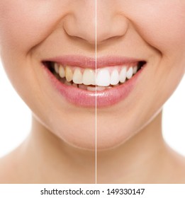 Before and after teeth bleaching or whitening treatment. Close-up of young Caucasian female's smile.   