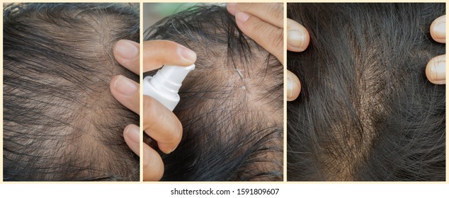 Before And After Thin And Thick Hair, The Hair Roots Are Dense.