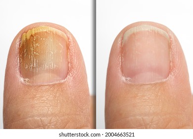 Before and after topical antifungal treatment is seen in the big toe of a person suffering from onychomycosis, a fungal infection causing yellowing of the toenail