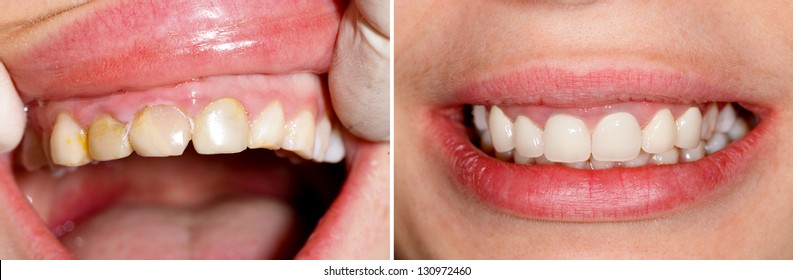 401 Bad Teeth Before After Images, Stock Photos & Vectors | Shutterstock