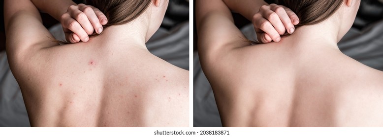 Before and after treatment acne pimples on skin back of teenager. - Shutterstock ID 2038183871