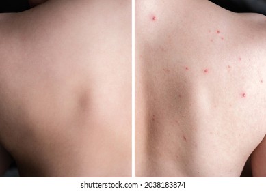 Before And After Treatment Acne Pimples On Skin Back Of Teenager.