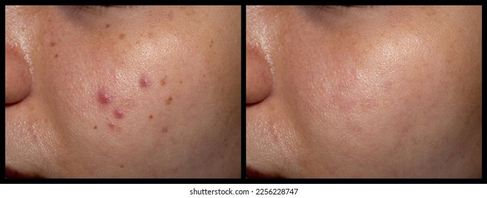 Before and after treatment of acne vulgaris, black spots and freckles on the oily face of Southeast Asian young woman.