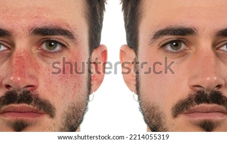 Before and after a treatment for acneiiform rosacea in a male face. Coupery on the cheeks and nose of a young man