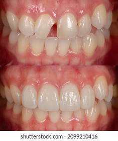 before and after treatment with dental veneers on four front teeth