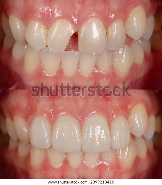 before and after treatment with dental veneers on\
four front teeth