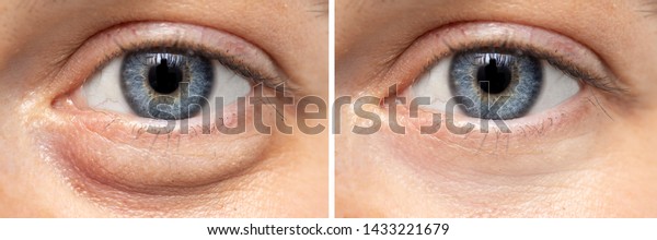 A\
before and after view on the eyes of a pretty young Caucasian\
woman, one show puffy dark circles beneath the eye, and the other\
shows flawless smooth skin after oculoplastic\
surgery.