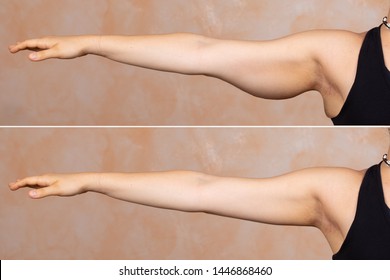 A before and after view of a young Caucasian lady who had a brachioplasty. Popular arm lift surgery which removes the sagging fat layer from the upper arm.