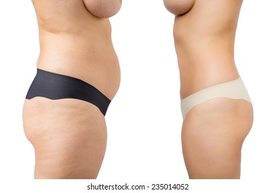 Before and after weight loss