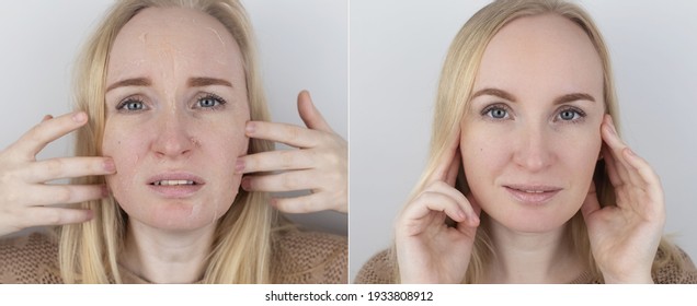 Before And After. A Woman Examines Dry Skin On Her Face. Peeling, Coarsening, Discomfort, Skin Sensitivity. Patient At The Appointment A Dermatologist Or Cosmetologist. Close-up Of Pieces Of Dry Skin