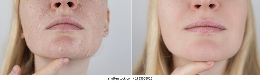 Vor und nach. Eine Frau untersucht trockene Haut auf ihrem Gesicht. Peeling, Grobheit, Unwohlsein, Hautempfindlichkeit. Patient bei der Ernennung eines Dermatologen oder Kosmetologen. Nahaufnahme von Teilen der trockenen Haut