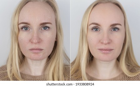 Before And After. A Woman Examines Dry Skin On Her Face. Peeling, Coarsening, Discomfort, Skin Sensitivity. Patient At The Appointment A Dermatologist Or Cosmetologist. Close-up Of Pieces Of Dry Skin