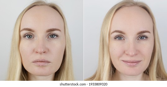 Before And After. A Woman Examines Dry Skin On Her Lips. Peeling, Coarsening, Discomfort, Skin Sensitivity. Patient At The Appointment A Dermatologist Or Cosmetologist. Close-up Of Pieces Of Dry Skin