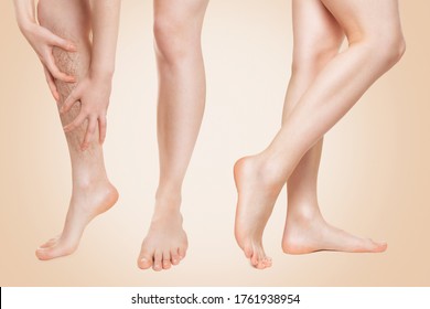 Before and after. The woman grabs the leg with her hands with diseased vessels, and then demonstrates the healthy legs after treatment. Beige background. The concept of varicose disease