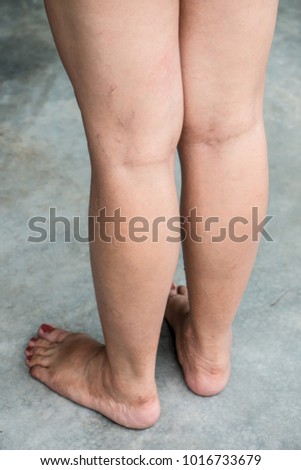 beginning of varicose veins beginning of varicose veins