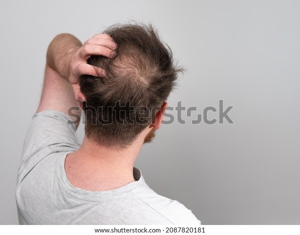 Behind view of a young balding man\'s head showing\
clear signs of balding and hair loss around the scalp. Male pattern\
baldness concept against a clear white background with room for\
text.