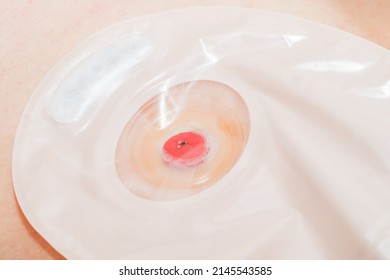 A beige transparent colostomy bag is glued to an adhesive circle around the small intestine on the abdomen of the human body, side view . Colostomy bag concept, abdominal diseases and colostomy bag re