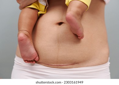 belly of woman with a c-section scar of caesarean. mother holding her baby