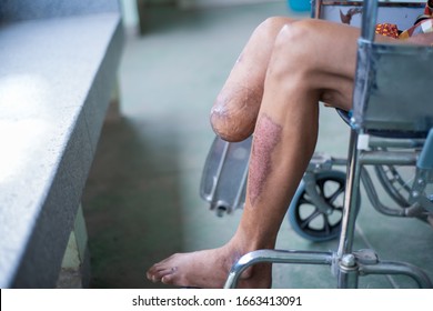 below knee amputated patient sitting on wheelchair, BK device prepared, stump bandage and strength leg