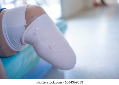 Below knee amputation bandaging for BK prosthesis