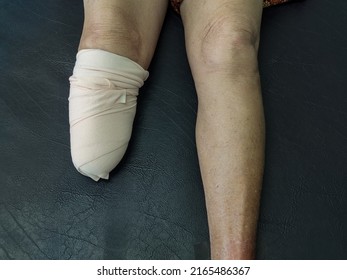 Below knee amputation bandaging for BK prosthesis.
