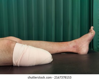 Below knee amputation bandaging for BK prosthesis.
