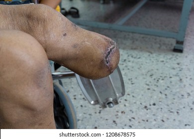 Below Knee Amputation, Close Up Left Stump Of Diabetes Patient With Post Amputee Operation 