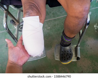 below knee amputation with elastic bandage 