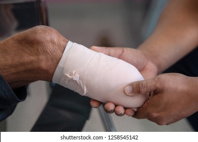 below knee amputation patient with elastic bandaging to prepare for leg prosthesis 