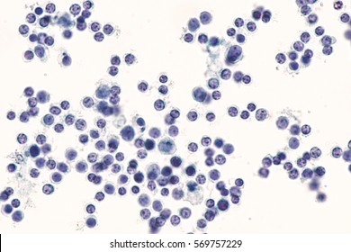 Benign Pleural Fluid Cytology: Chronic Inflammatory Cells (lymphocytes) Admixed With Mesothelial Cells In A Patient With Chronic Lung Disease. No Malignant Cells Are Identified..