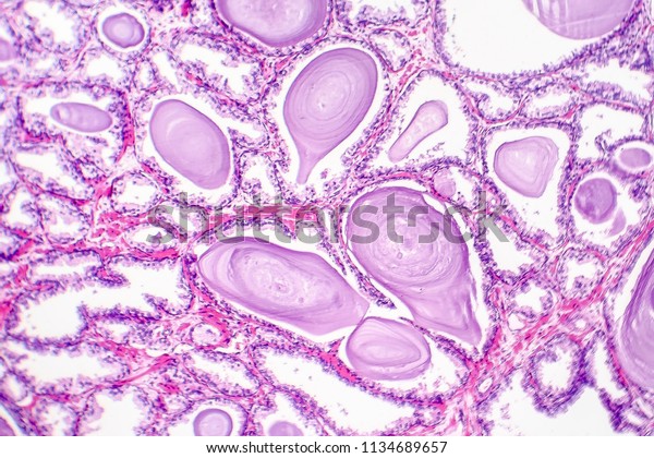 patología de la hiperplasia prostática benigna