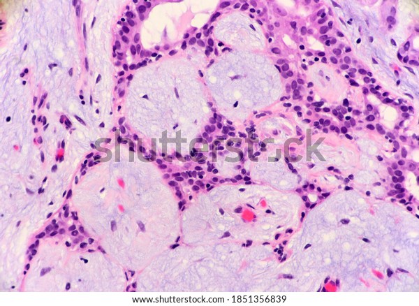 Benign Tumor Breast Called Fibroadenoma Notice Stock Photo 1851356839 ...