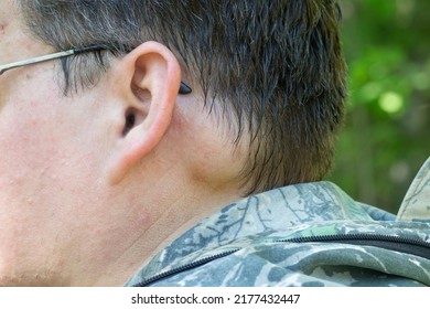 A Benign Tumor On A Person's Head Behind The Ear.