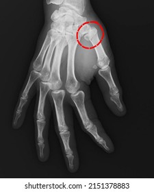 Bennetts Fracture Break Base Your Thumb Stock Photo 2151378883 ...