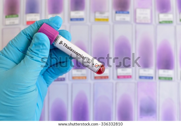 Betathalassemia Blood Sample Stock Photo (Edit Now) 336332810