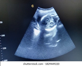 Bi Lateral Choroid Plexus Cysts Fetal Hydrocephalus By Ultrasound