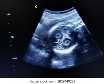 Bi Lateral Choroid Plexus Cysts Fetal Hydrocephalus By Ultrasound