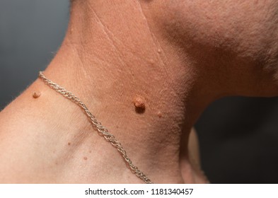 papilloma in neck)