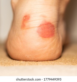 Big Bloody Callus On Womans Heel Stock Photo 1779449393 | Shutterstock