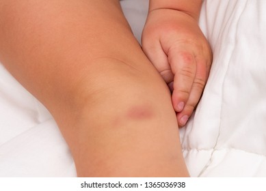 Big Bruise On Baby's Knee