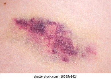 Big Bruise On The Girl's Skin Close Up