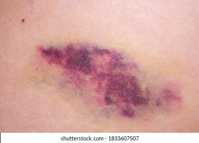 Big Bruise On The Girl's Skin Close Up