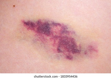 Big Bruise On The Girl's Skin Close Up