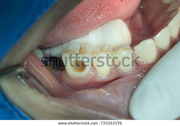 Big Hole Tooth Stock Photo (Edit Now) 733263196