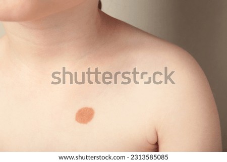 Big mole. Birthmark on body of a child. Top view