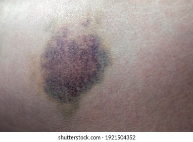 Big Purple Bruise On A Leg