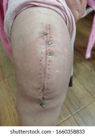 Big Scar After A Knee Surgery