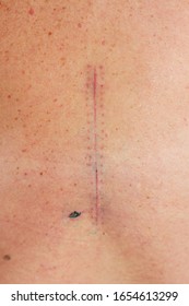 Big Scar From Surgery To Remove A Tumor On The Human Spine